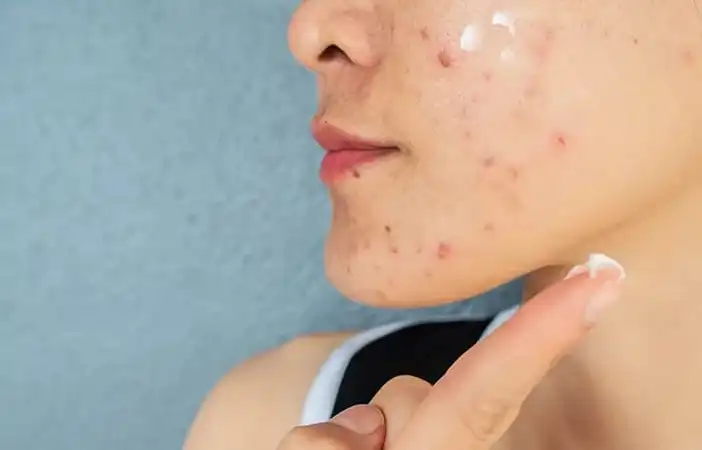 Rekomendasi Micellar Water untuk Kulit Berminyak dan Berjerawat