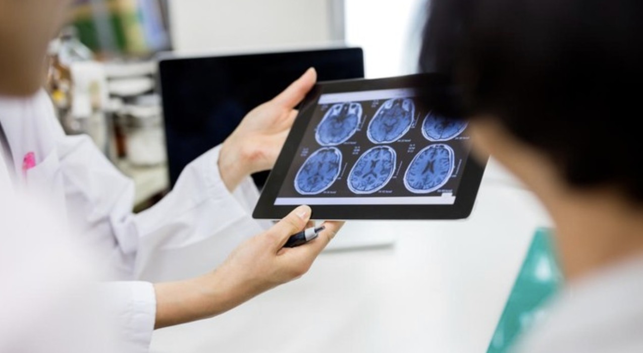 10 Gejala Awal Tumor Otak yang Sering Diabaikan, Jangan Sampai Terlambat