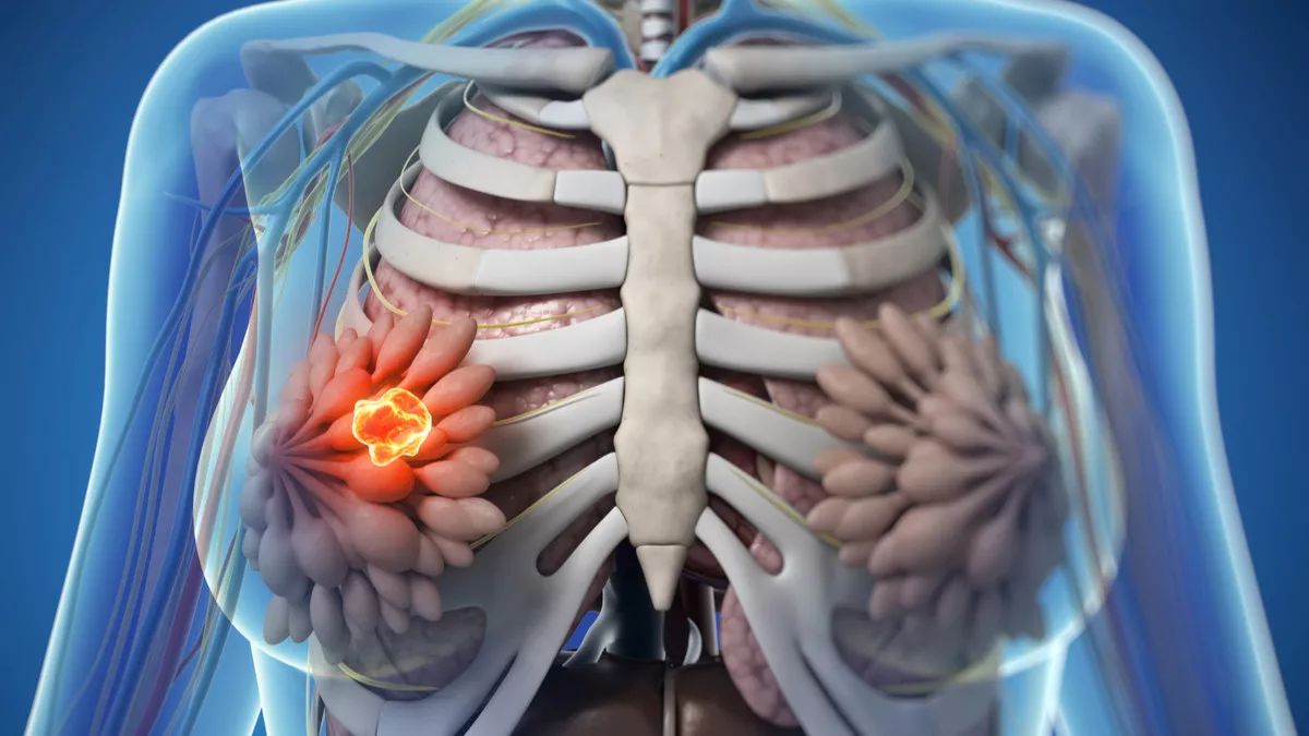 7 Penyebab Denial pada Kanker Payudara &amp; Dampak Fatalnya bagi Pasien Indonesia