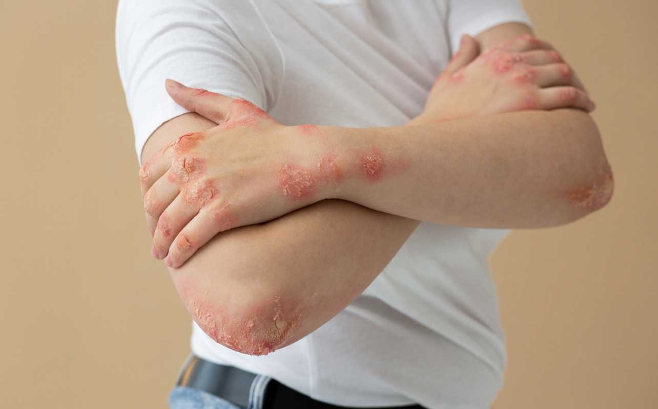 Waspada Kusta: Gejala Awal di Kulit yang Sering Diabaikan Masyarakat